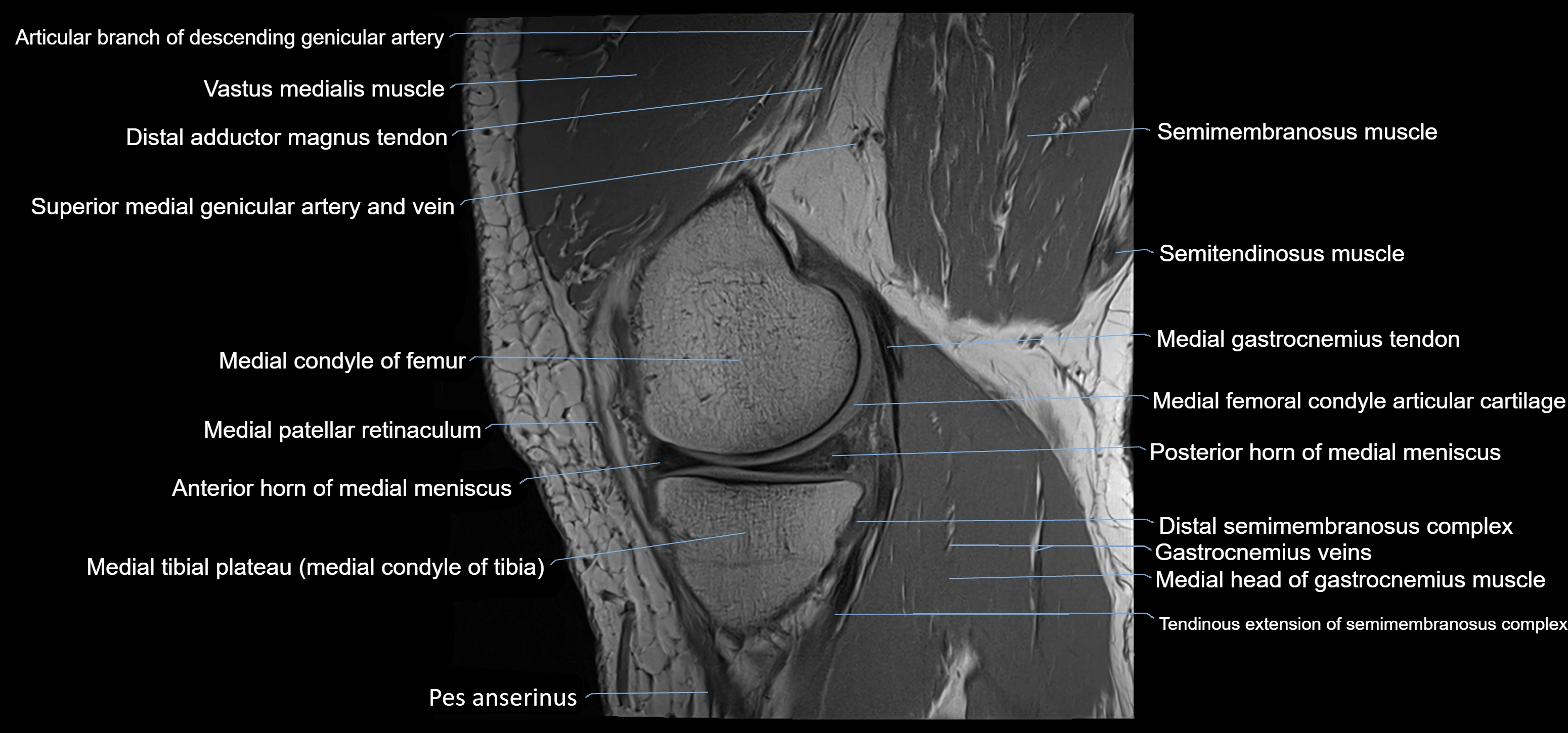 MRI knee sagittal cross sectional anatomy labelled 3T radiology image-00014.webp